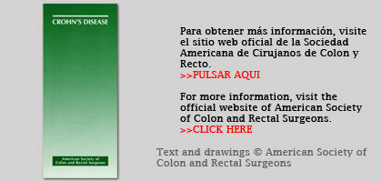 Crohn’s disease