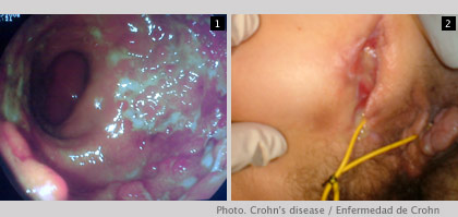 Crohn