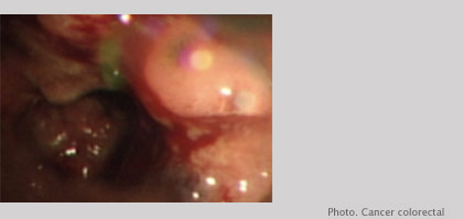 Cancer colorectal